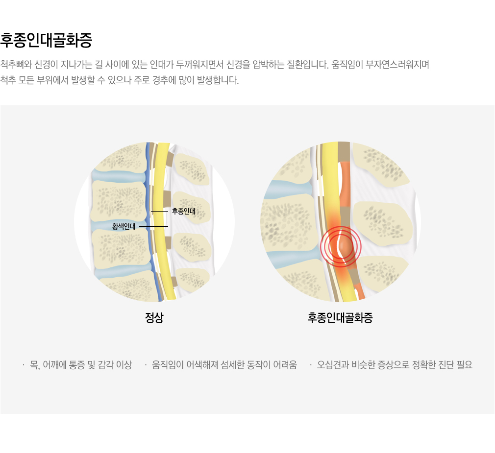 내시경 치료 가능한 척추질환