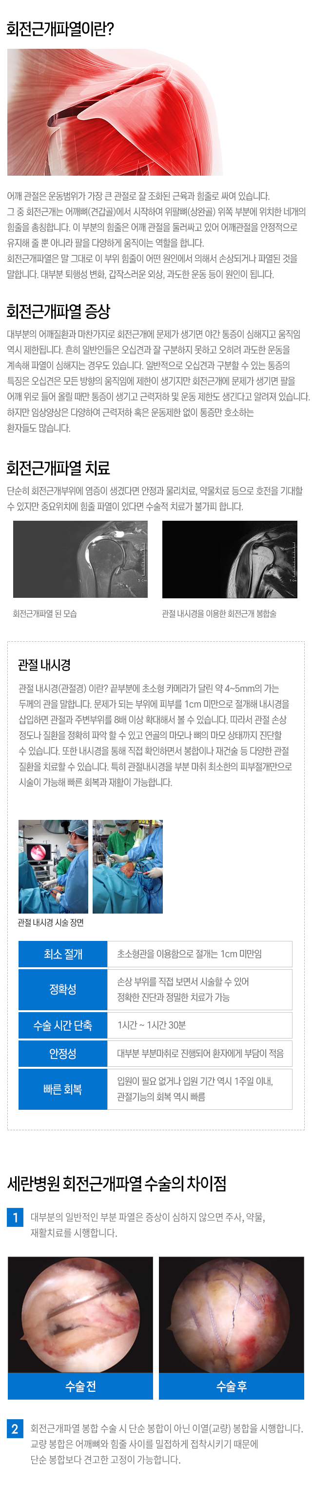 회전근개파열