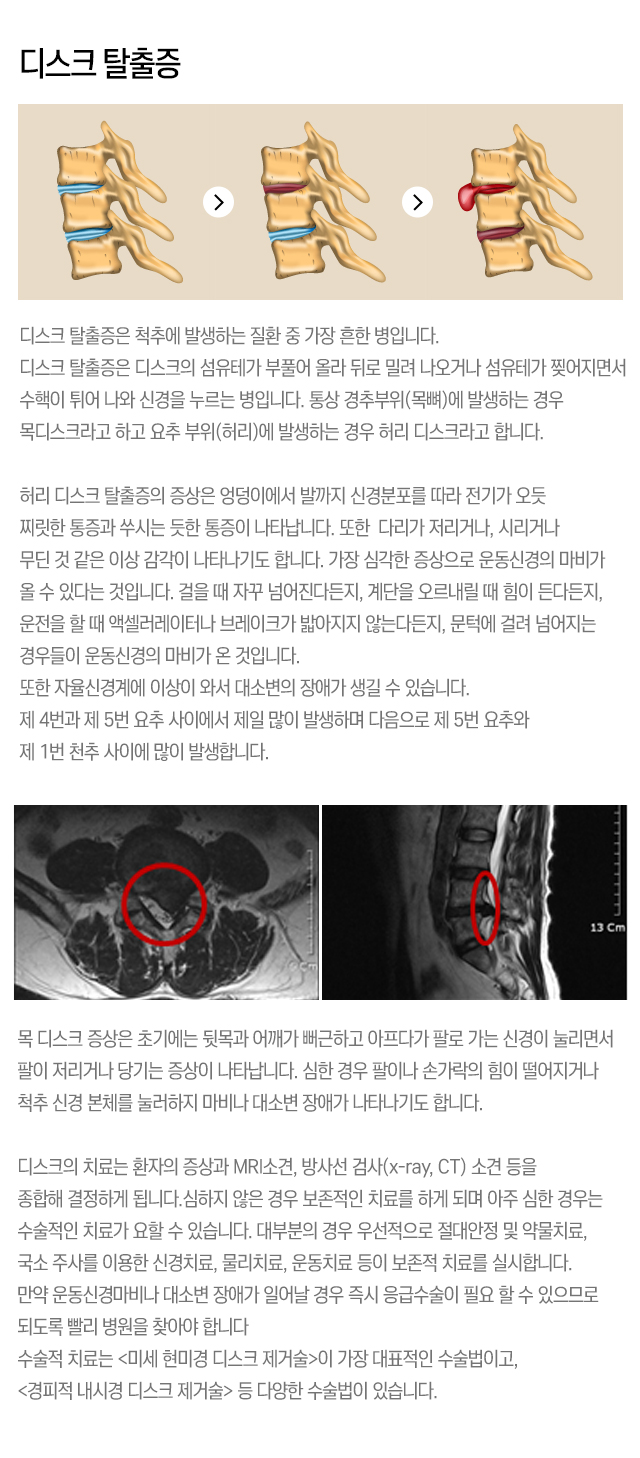 허리디스크