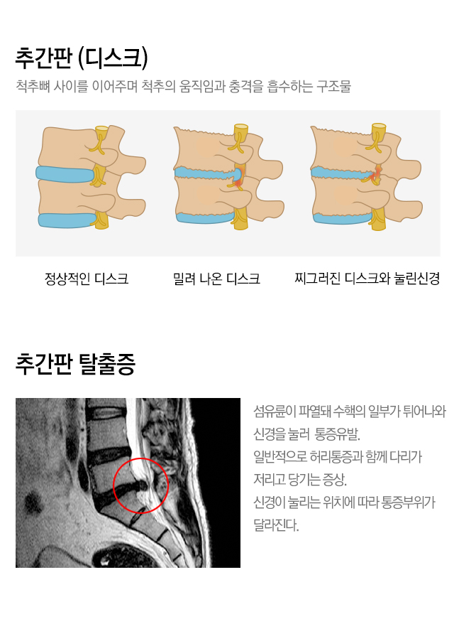 내시경 치료 가능한 척추질환