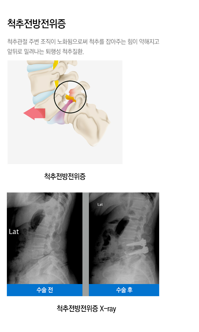 내시경 치료 가능한 척추질환