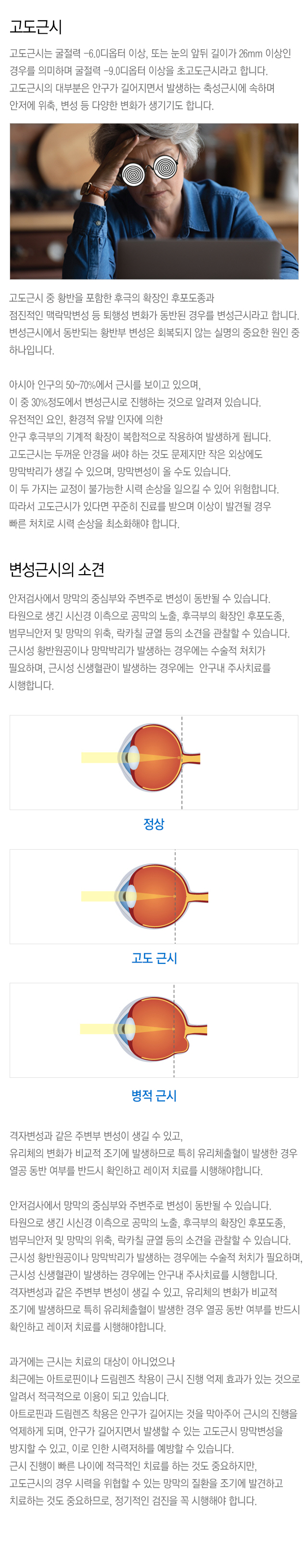 고도근시&변성근시