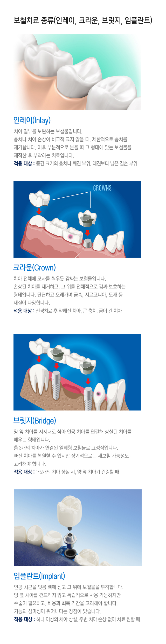보철치료 종류