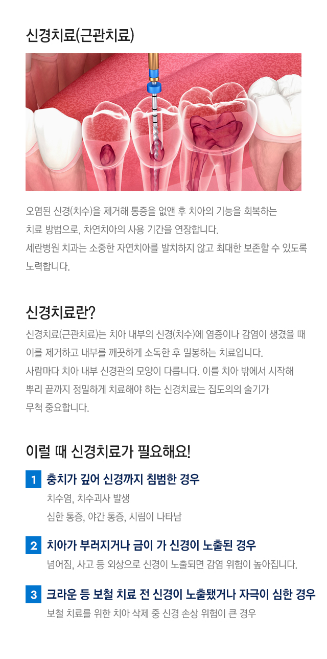 신경치료란