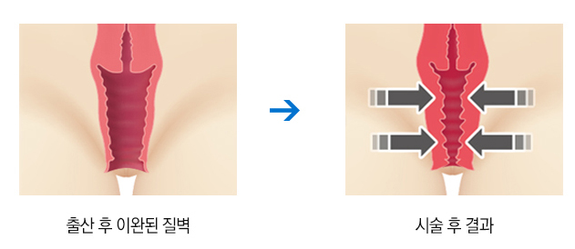 레이저 질재생술