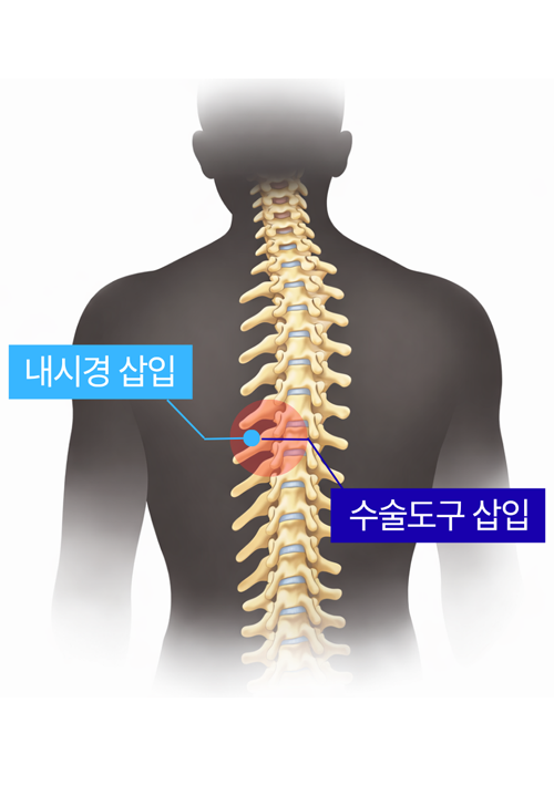 단일공 척추 내시경