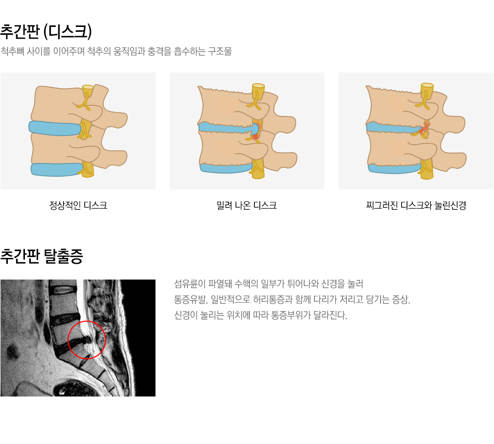 내시경 치료 가능한 척추질환